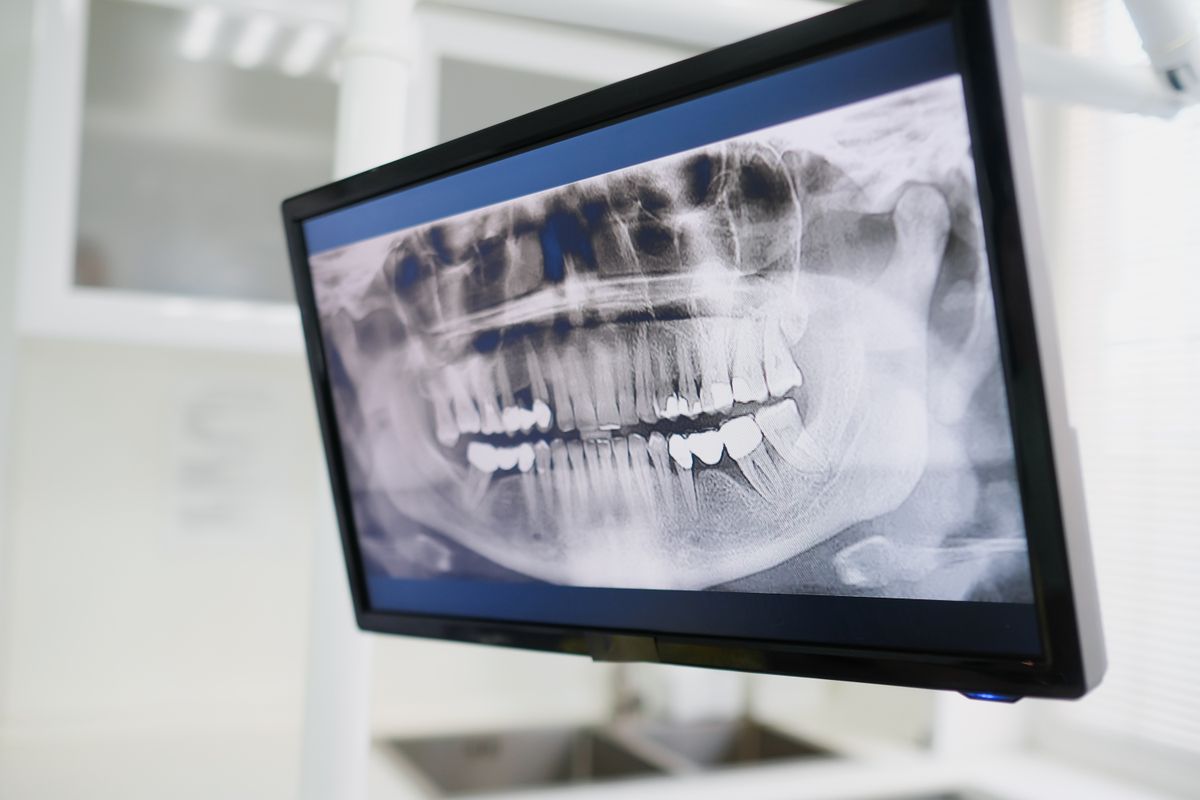 Pantalla mostrando una radiografía dental durante la planeación quirúrgica